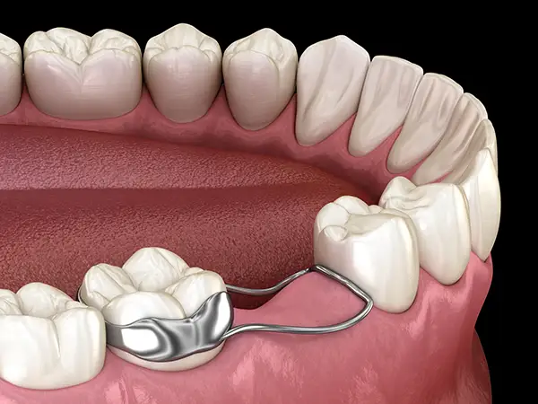 Close up of a wire space maintainer preventing the teeth from shifting after tooth loss.